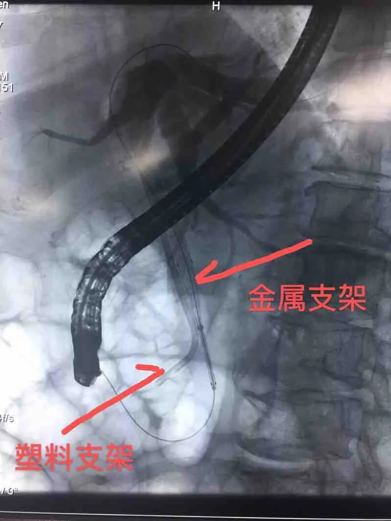 普外一科最终为患者制定了创伤最小的治疗方式:ercp下胆管支架