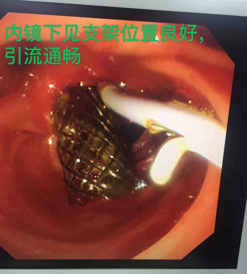 普外一科最终为患者制定了创伤最小的治疗方式:ercp下胆管支架