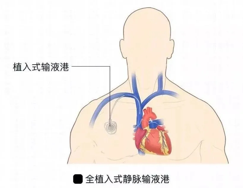 输液港结构图片